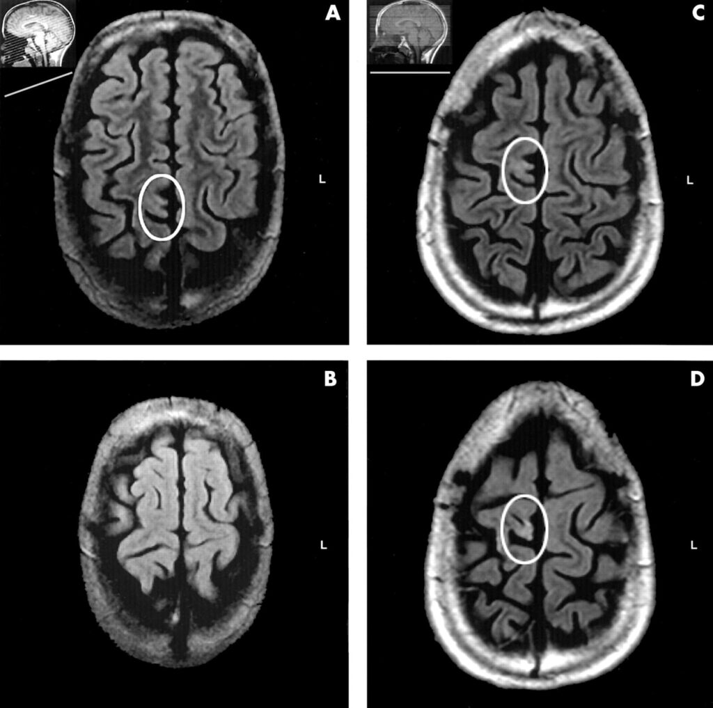МРТ головного мозга при эпилепсии в Алматы: цена, запись - ExpertNeuro