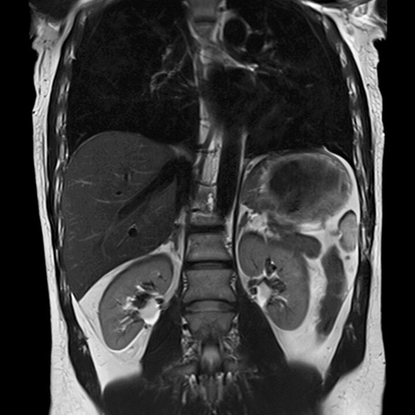 Снимок МРТ спины в png