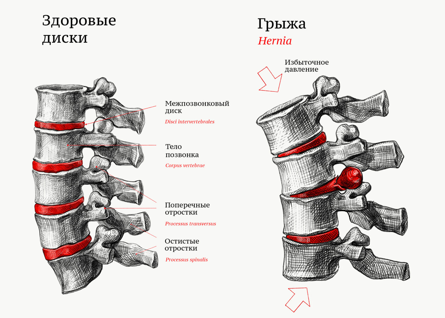 Диск лечение остеохондроза. Грыжи позвоночника в поясничном отделе схема. Остеохондроз позвоночника схема. Остеохондроз протрузии межпозвонковых дисков. Остеохондроз протрузии грыжи.