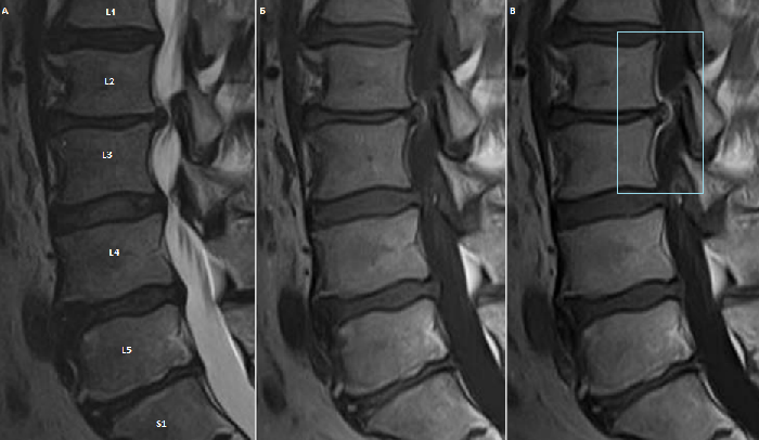 Протрузия поясничного отдела фото. Протрузия на мрт поясничного отдела. Мрт позвоночника протрузия. Мрт протрузии поясничного отдела позвоночника. Протрузия дисков позвоночника мрт.