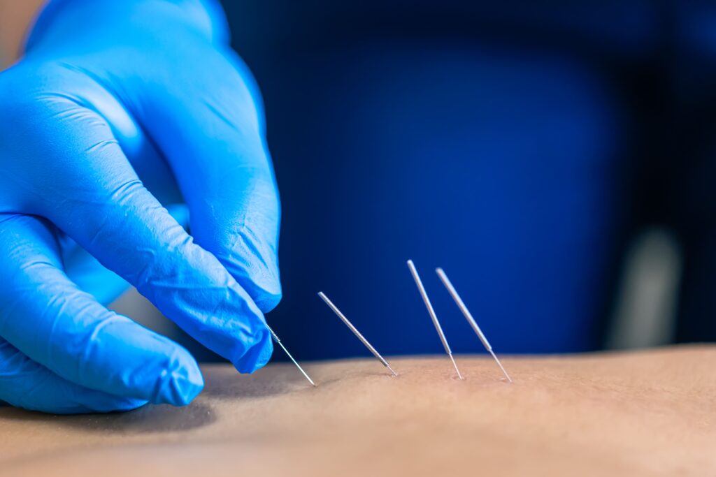 Проведение процедуры Dry needling в клинике ExpertNeuro в Алматы